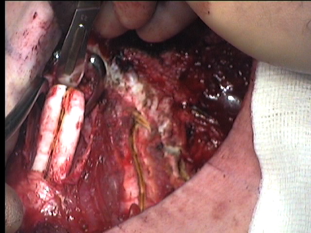 Cutting cartilage