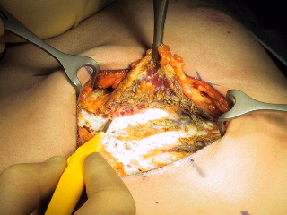 Pectoral muscle flap