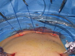 Percutaneous_sutures.JPG