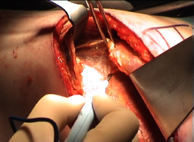 Serratus2