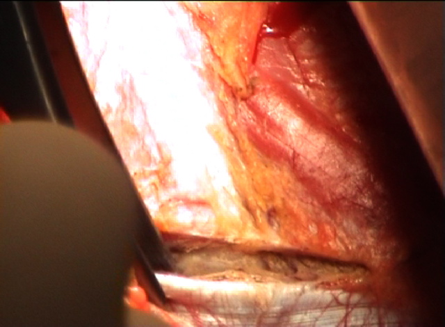 Erector spinae