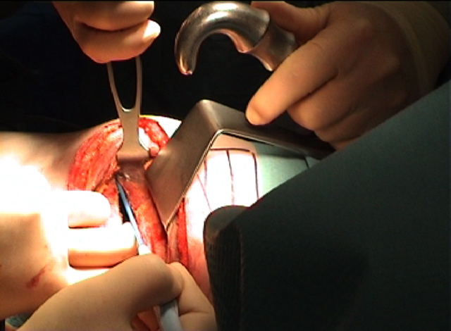 Distal_intercostal