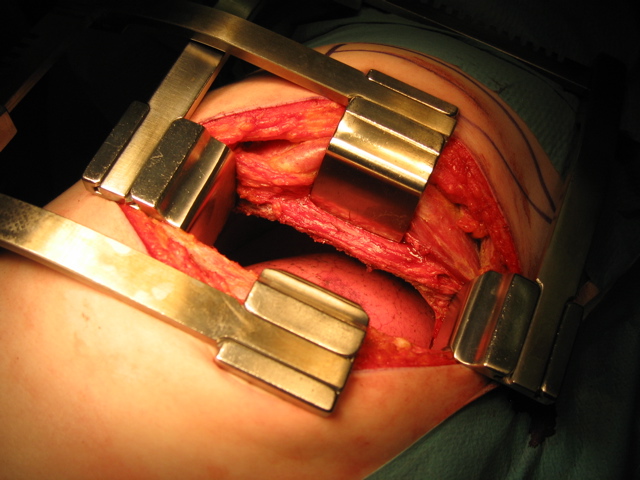 Second_retractor.JPG
