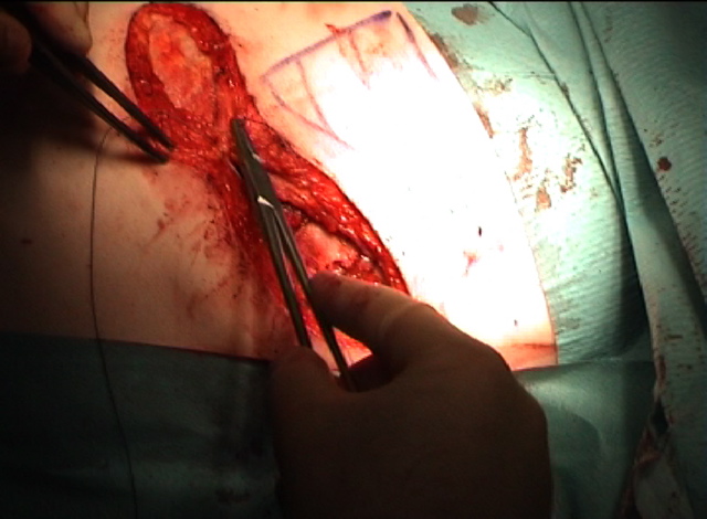 Subcutaneous_closure