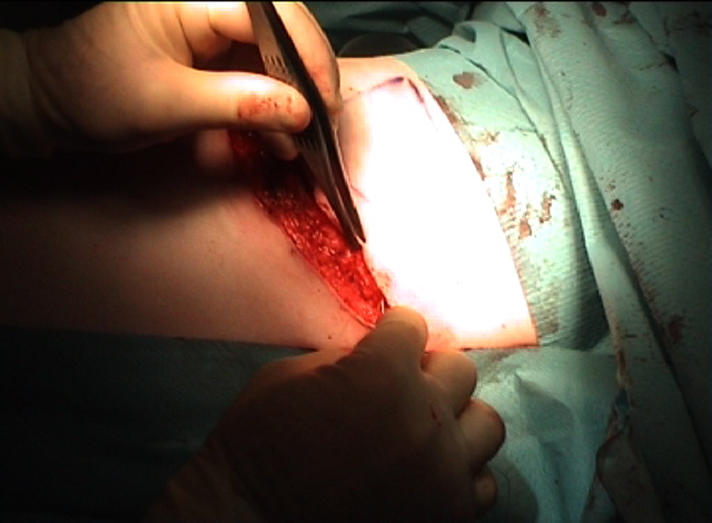 Subcuticular