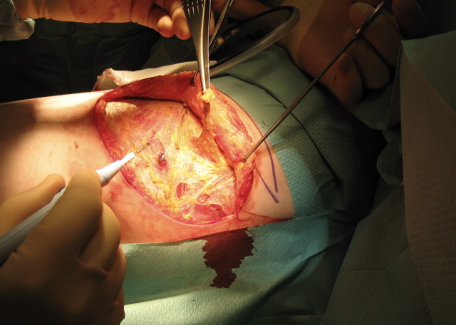Triangle_fascia.JPG