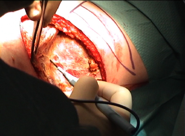 Latissimus