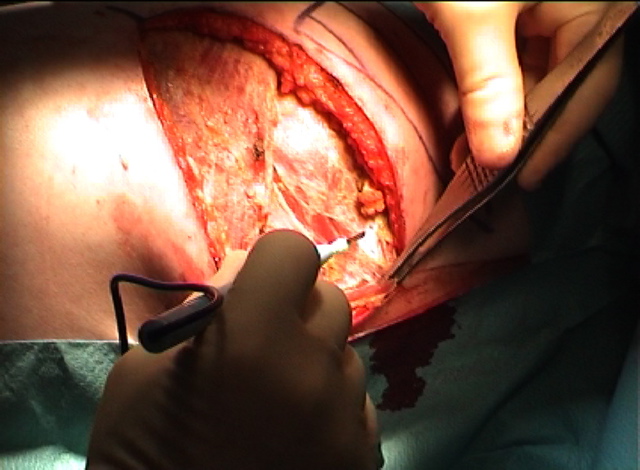 Trapezius2
