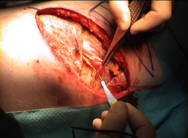 Serratus1