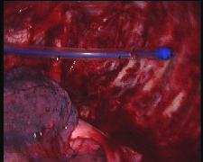 Figure 13. Placing the apical drain