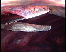 Figure 7. Cutting the pleura